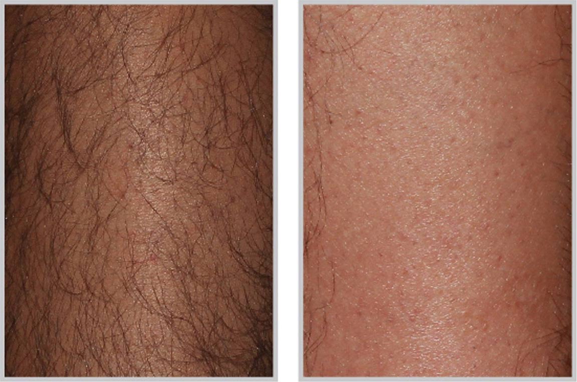 laser hair removal before and after patient laser hair removal before and after patient