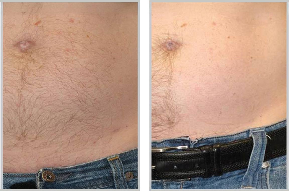 laser hair removal before and after laser hair removal before and after